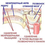 НЕВРАЛГИЯ МЕЖРЕБЕРНАЯ — 10 дней фото
