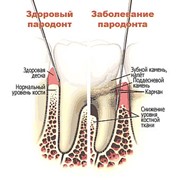 Пародонтология фото