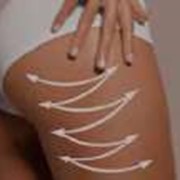 SPA-Лeчeниe цeллюлитa фото