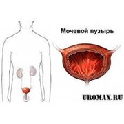 Простатит фото