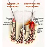Пародонтологическое лечение фото