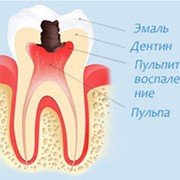 Лечение пульпита в Алматы фото