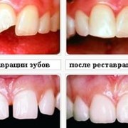 Художественная реставрация зуба фото