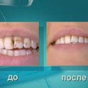 Лечение кариеса фото