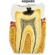 Лечение кариеса фото