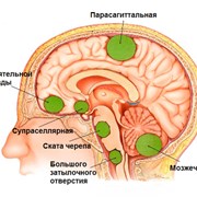 Распространенные опухоли мозга фотография