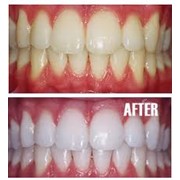 Отбеливание зубов с IONIC WHITE фото
