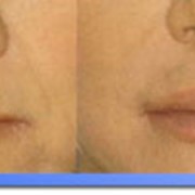 Коррекция губ, устранение носогубных складок и увеличение губ фото