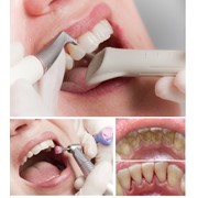 Профессиональная чистка зубов фото