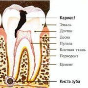 Киста зуба лечение в Киеве. Способы и методы лечения кисты зуба в Киеве фото