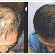 Восстановление волос, решение проблемы волос в Астане фото