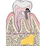 Endodontie фото