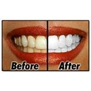 Отбеливание зубов по технологии Zoom 3 фото