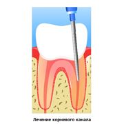Лечение зубных каналов фотография
