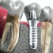 Имплантология - имплантация зубов фото