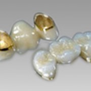 Протезирование зубов с использованием металлокерамики