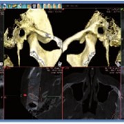 Анализ височно-нижнечелюстного сустава, томограф компьютерный конусно-лучевой WhiteFox