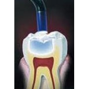 Пломбирование зубов. Стоматологический кабинет ТРИО фото