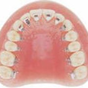 Выравнивание зубного ряда в алмате