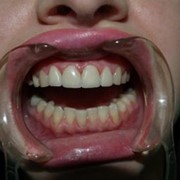 Протезирование зубов несъемное фото