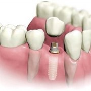 Имплантация зубов в Алматы