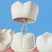 Протезирование зубов несъемное