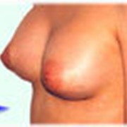 Маммопластика (увеличение груди) фотография