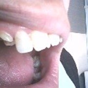 Художественная реставрация зуба фото