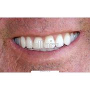 Протезирование зубов бюгельное фотография