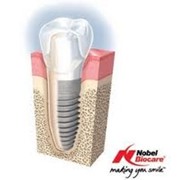 Имплантанты зубов Nobel Biocare (США, Швейцария)