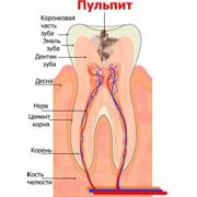 Пульпит