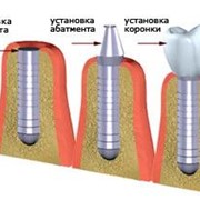 Имплантация зубов фотография