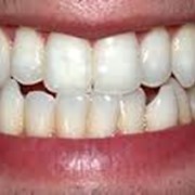 Имплантация зубов фото