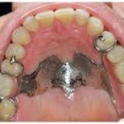 Бюгельное протезирование зубов