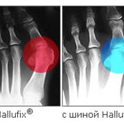 Бурсит большого пальца стопы Hallux valgus (болезненная косточка) фото