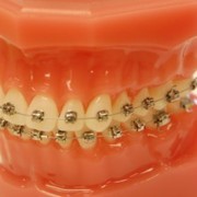 Ортодонтия фотография