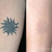 Удаление татуировок лазером фотография