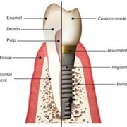 Имплантация зубов фотография