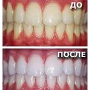 Отбеливание зубов фотография