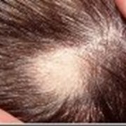 Лечение болезней волос