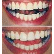 Реставрация зубов фотография