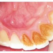 Лечение и реставрация зубов фотография