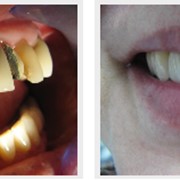 Художественная реставрация верхней фронтальной группы зубов после снятия металлокерамического моста с последующим шинированием