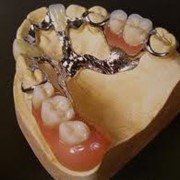 Бюгельное протезирование зубов фото