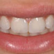 Эстетическая реставрация зубов фото