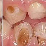 Серебрение зубов фотография