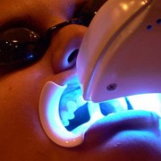Отбеливание зубов лазерное в Алматы фото
