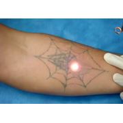 Удаление татуировок и перманентного макияжа на аппаратах ND-YAG лазер фото