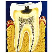 Лечение кариеса некариозных поражений зубов