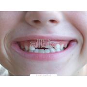 Лечение зубов у детей фото